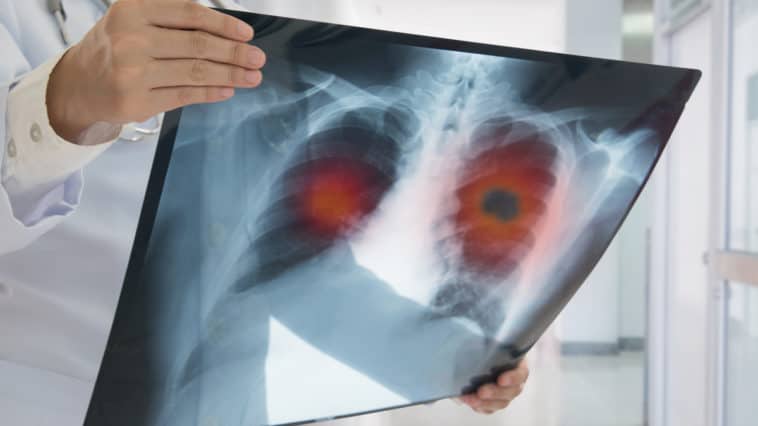 Gute Nachrichten zum Weltkrebstag Bahnbrechende Therapiefortschritte bei Lungenkrebs